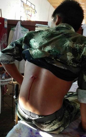 A KIA soldier displays his bullet wound from recent clashes with the Burma Army.
