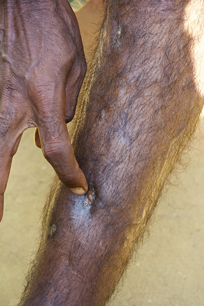 A Rohingya man points to a bullet wound in his leg where he was shot by the Burma Army while fleeing.