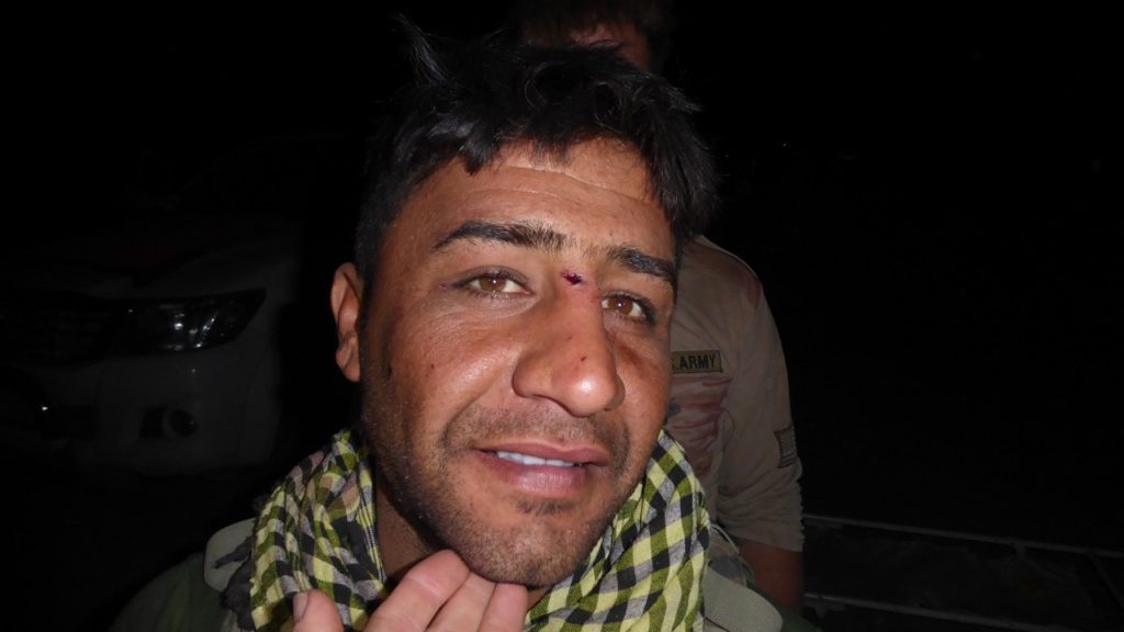 Kurd wounded in the face - fragment lodged in bridge of nose Photo; FBR