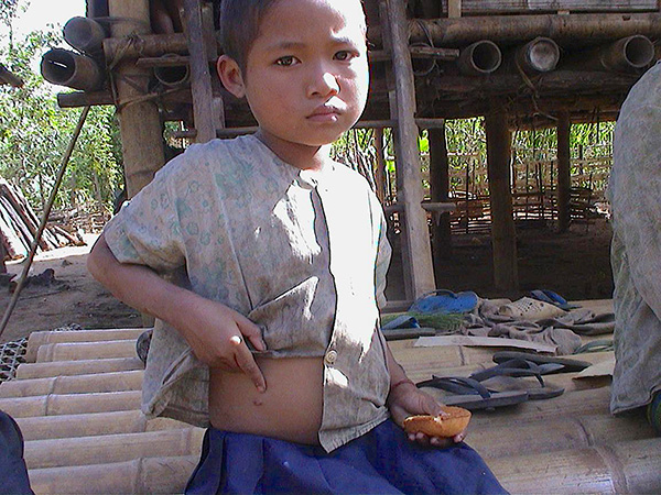 Naw Moo Day Wah, 8-years old in 2002, pointing to entry wound of bullet 