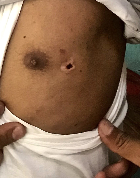 The ARSA member's wound from being shot in the chest in a refugee camp. He survived but feels the reach of the Burma Army and their allies.