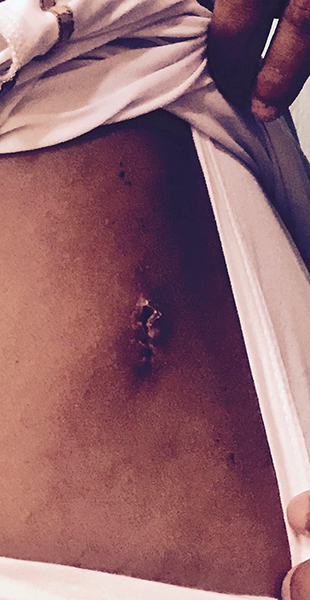 Exit wound in his back.