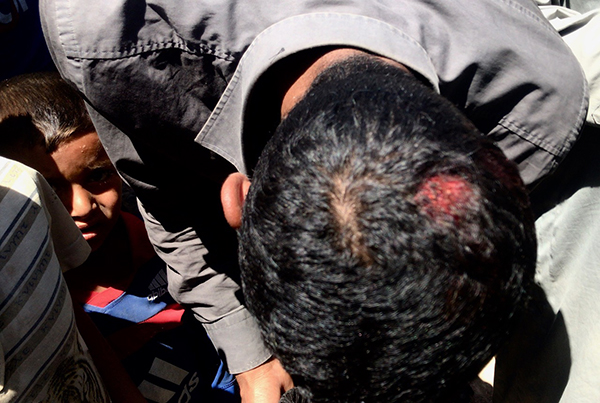 An Iraqi man, now trapped with his family between two sides and who was tortured by a Turkish supported militia (Free Syrian Army), shows his wounds