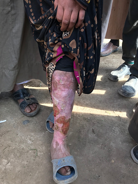 Another girl who fled ISIS shows her burned leg.