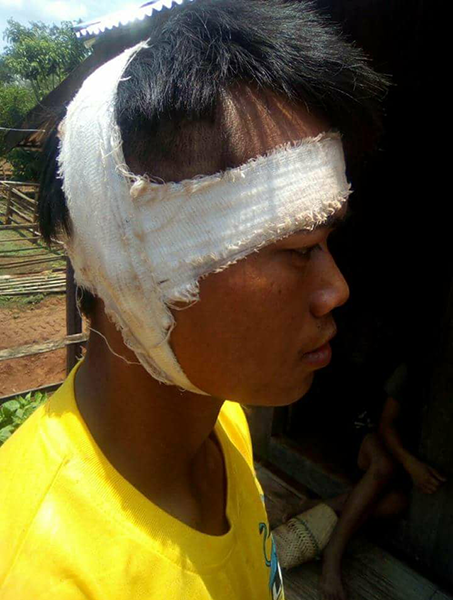 Khun Mg Loi after receiving treatment from having his ear cut off by the Burma Army.