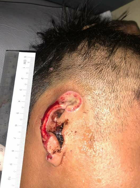 Khun Mg Loi’s ear after the attack.