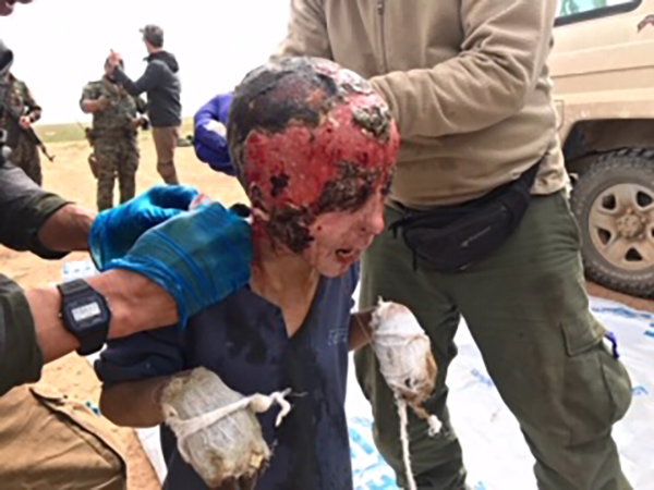 A boy, who was hit by mortar, being treated by our team. For video, please click the photo.